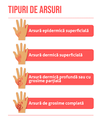 Agrimensură ambușură arsură broșură comisură contramăsură desfășura fisură fisura hașură hașura înfășura însura. Arsuri Èi OpÄriri Medic Chat