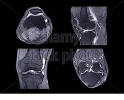 Clinical questions & relevance 2 clinical indications knee/kneecap pain, weakness axial/transverse: Magnetic Resonance Imaging Or Mri Knee Comparison Axial Coronal Sagittal And Acl View View For Detect Tear Or Sprain Of The Anterior Cruciate Liga Stock Photo Alamy