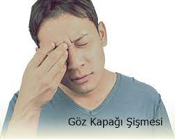 Goz Kapagi Sismesi Gozler