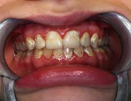 Ab wann geht eine gratis zahnspange? Zuzahlung Bei Zahnspangen Zahnarztpraxis A Kanev