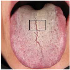 Sampling Images Of Tongue Coating From The Centre Of The