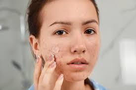 Namun sebelum mengkonsumsi obat tradisional asam lambung ini ada baiknya anda memastikan bahwa anda tidak memiliki riwayat tekanan darah rendah sebab. Hilangkan Jerawat Dengan Tampal Pimple Patch Berkesan Ke