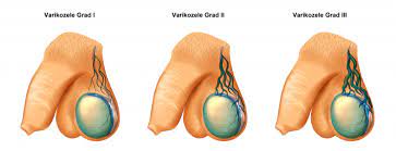 Die varikozele ist eine durch insuffizienz der venenklappen entstandene, krankhafte erweiterung und verlängerung des plexus pampiniformis. Manner Mit Varikozele Mussen Sich Nicht Schamen