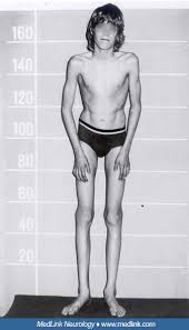 Image result for Homocystinuria