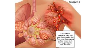 Semakin tinggi angkanya, berarti semakin jauh sel. Kanker Payudara Stadium 4 Bisa Sembuh Deherba Com