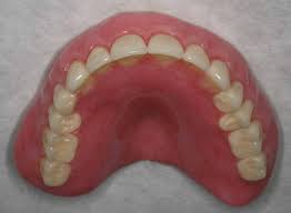 Maison 1953 classified the common anatomic abnormal difficulties of the mouth condemned, for the retention of the full lower denture is most dependent up on the retromolar pad. Immediate Dentures For Org