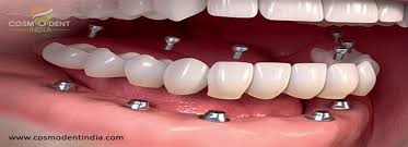 Find content updated daily for replace teeth cost. How Much Does It Cost For Full Dental Implants