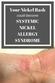 Your Nickel Rash Could Become Systemic Nickel Allergy Syndrome