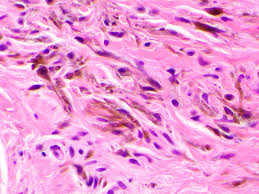 Image result for Blue Nevus