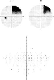 Image result for Visual Field Deficit