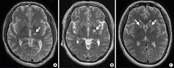 Image result for Pallidotomy