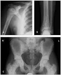Clinical, genetic and radiologic considerations. Differentiating Osteopoikilosis From Osteoblastic Metastases