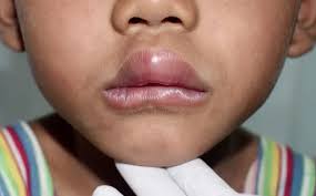 Image result for Angioedema