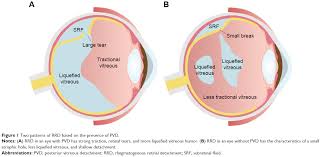 We did not find results for: Scleral Buckling In The Management Of Rhegmatogenous Retinal Detachmen Opth