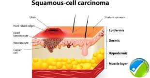 Squamous Cell Carcinoma Know Its Causes And Treatment Squamous Cell Squamous Cell Carcinoma Squamous