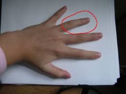 Ring Cleaning Avoid The Ring Finger Rash Wedding Ring Rash Ring Finger Clean Rings