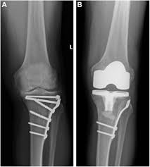 Image result for Traumatic Arthrotomy