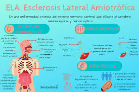 Sumario ‐ ¿qué es la esclerosis lateral amiotrófica? Esclerosis Lateral Amiotrofica Ela Somosdisc