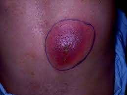 Image result for wolf spider bite skin