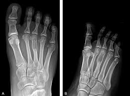 Image result for Ewing Sarcoma