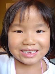 Ruby missing teeth 5years