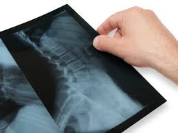 Image result for Alternative Scoliosis Treatment - Promising Technologies Lead The Way