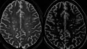 7-tesla MRI shows promise in detailing MS lesions