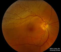 Image result for Acute Vision Loss