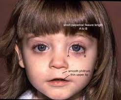 WA State FAS DPN Patient Profile (n = 1,400)