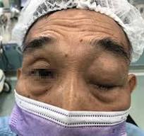 6旬男眼腫睜不開就醫發現眼窩淋巴長瘤- 自由健康網