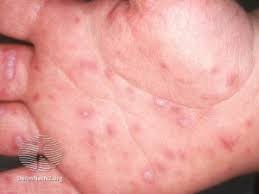 Image result for Hand foot and mouth disease HFMD roof of mouth