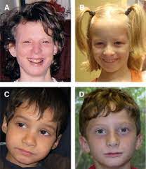Identification Of Uncommon Recurrent Potocki Lupski Syndrome Associated Duplications And The Distribution Of Rearrangement Types And Mechanisms In Ptls Sciencedirect