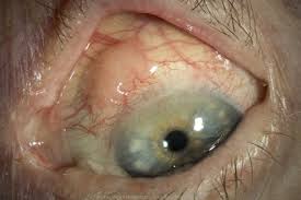 Image result for conjunctival melanoma