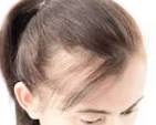 5 Illnesses That Cause Hair Loss in Women - Harley Street HTC