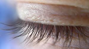 See full list on mayoclinic.org 3 Steps To Get Rid Of A Stye On Your Eyelid Baptist Eye Surgeons