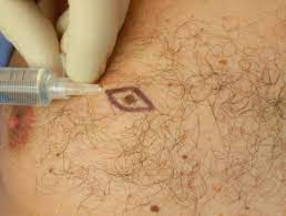Your stomach is located on the left side of your body in your upper abdominal cavity. Do I Have Melanoma Dermnet Nz