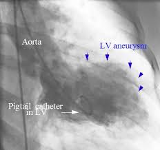 Image result for Nuclear Ventriculogram