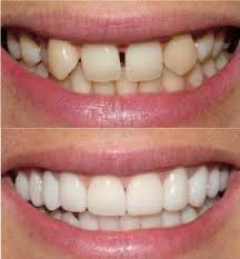  răng sứ-răng sứ thẩm mỹ-làm răng sứ-bọc răng sứ