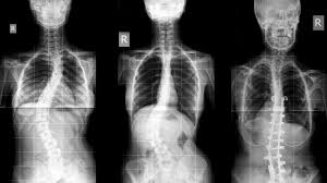 Can Adults Develop Scoliosis Scoliosis Scoliosis Treatment Surprising Facts
