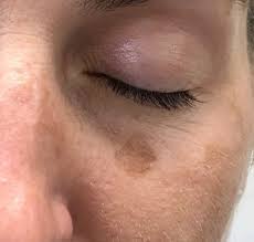 Image result for Solar Lentigo