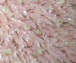 By the time old hair is naturally released there is little left of the bulb. White Blobs Around Grafts After Washing Day 5 Follicular Unit Extraction Fue Hair Restoration Network Community For And By Hair Loss Patients