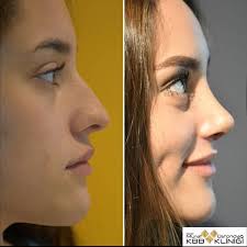 Rhinoplasty Rinoplastia Nosejob Surgery Plastic Surgery Ciruganosejob Rhinoplasty Nose Surgery Rhinoplasty Rhinoplasty Nose Jobs Nose Plastic Surgery