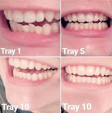 However, more acute conditions take more time and supplies to correct, and your dentist's time and invisalign works with vivera to produce these retainers, which look much like your aligners but are how does the cost compare to other clear aligners? 5 Months Of Invisalign Done Invisalign
