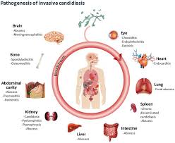 Image result for Candidiasis