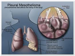 malignant pleural mesothelioma (mpm) is a highly aggressive malignant tumor that arises from mesothelial cells of pleural cavity. Pleural Mesothelioma My Blog