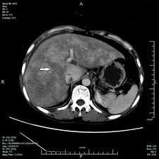 Computed Tomography Findings Of Hepatic Veno Occlusive Disease Caused By Sedum Aizoon With Histopathological Correlation