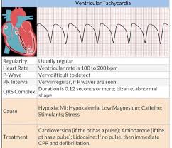 Pin By Ayanna Antoine On Medical Nursing Study Tips Ventricular Tachycardia Nurse