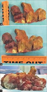 Image result for cornu cutaneum)