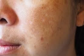 Sekarang mencuci muka dengan menggosok lembut. Flek Hitam Semakin Banyak Ini 4 Cara Mengatasinya