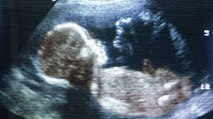 Auch frauen, die aus verschiedenen gründen nicht bereit für ein kind sind und es abtreiben möchten, sollten möglichst rasch zum arzt gehen. Schwangerschaft Zu Viel Ultraschall Beim Frauenarzt Gesundheit Sz De